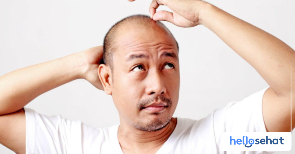 Perawatan Rambut Botak, Apa yang Perlu Diperhatikan?