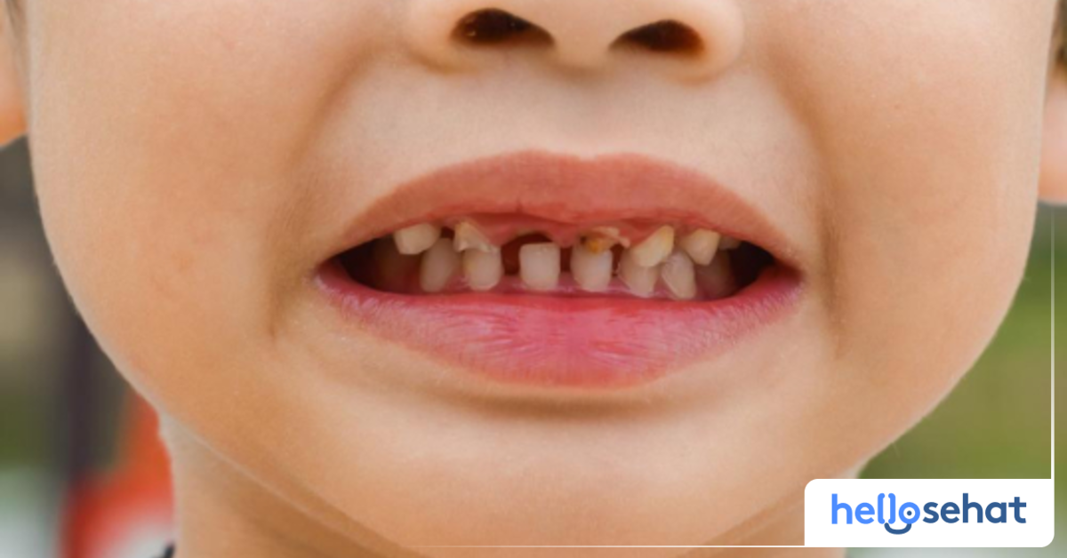 5 Penyebab Gigi Anak Rusak dan Tips Perawatannya - Hello Sehat